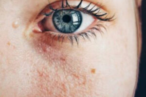 Atopowe zapalenie skóry